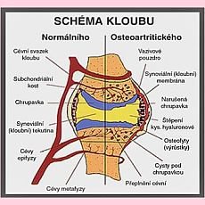 Víte, jak správně vybrat kloubní výživu?