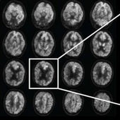 AI zvládla diagnostikovat Alzheimera mnohem dříve než klinické metody