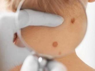 Dermatoskopické vyšetrenie všetkých materských znamienok na tele