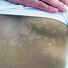 Barvu měnící skvrny na kůži: Pityriasis versicolor