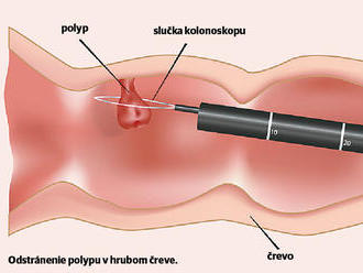 Gastroenterológ Kužela ukáže, ako prebieha kolonoskopia