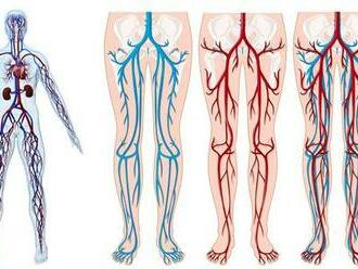 Kŕčové žily dolných končatín číhajú kedykoľvek na kohokoľvek.