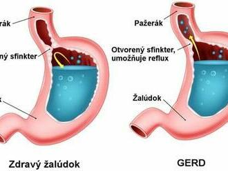 Refluxná choroba pažeráka stúpla desaťnásobne.