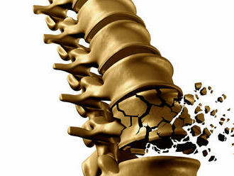 Osteoporóza: Choroba bez príznakov, ktorá ohrozuje život