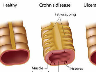 Po poslednej operácii bolestivo schudol 30 kíl. Aj to prináša Crohnova choroba