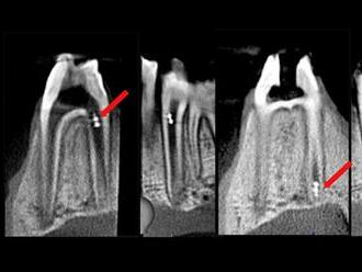 Vďaka novej technológii by sa nám zuby v budúcnosti mohli starať nanoroboti