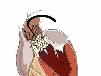 Světový den srdce: Až 2500 pacientům ročně může pomoci bezbolestná metoda TAVI
