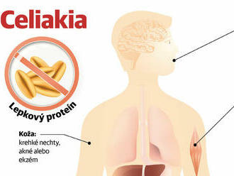 Čo môže urobiť laik, ak má podozrenie na celiakiu? Toto je najhoršie rozhodnutie