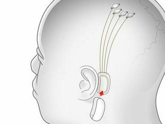 Muskova firma Neuralink implantovala mozgový čip prvému človeku