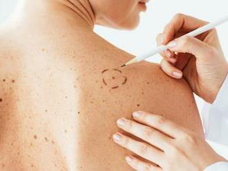 4 veci, ktoré odhalia rakovinu kože: Ak toto zbadáte, utekajte k lekárovi!