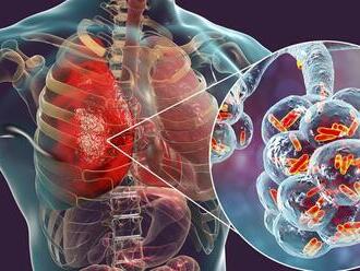 V Česku pribudlo NAJVIAC prípadov vážneho ochorenia v tomto roku! Koho ohrozuje?