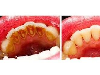 Zbavte sa zubného kameňa a problémov s ďasnami!